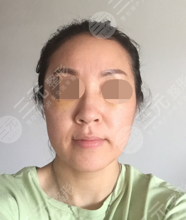 面部年輕化plus全臉，快速解決面部問題，內(nèi)附真實案例分享圖