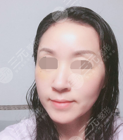 面部年輕化plus全臉，快速解決面部問題，內(nèi)附真實案例分享圖