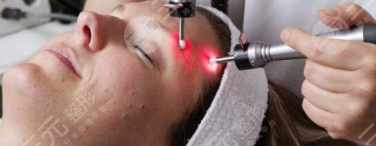 像素激光緩解痘疤的原理