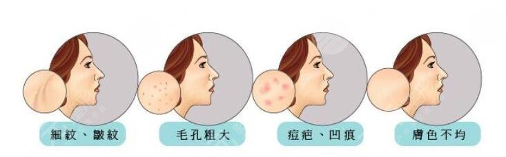 像素激光緩解痘疤的價(jià)格