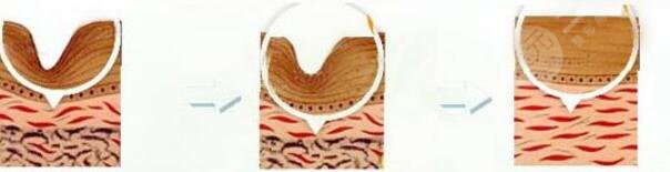 像素激光緩解痘疤后注意什么