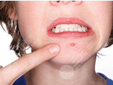 像素激光緩解痘疤后注意什么