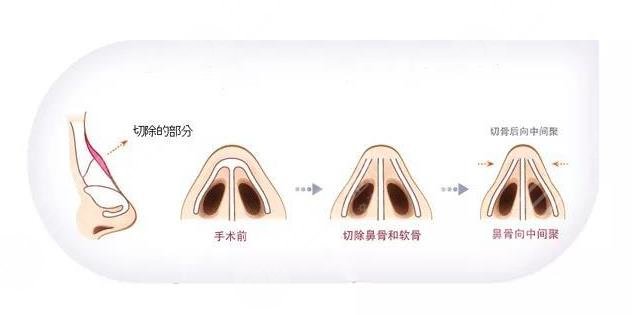 駝峰鼻手術(shù)
