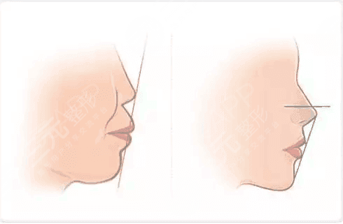 齙牙怎么矯正？如何解決齙牙這個問題，成為了他們的重中之重