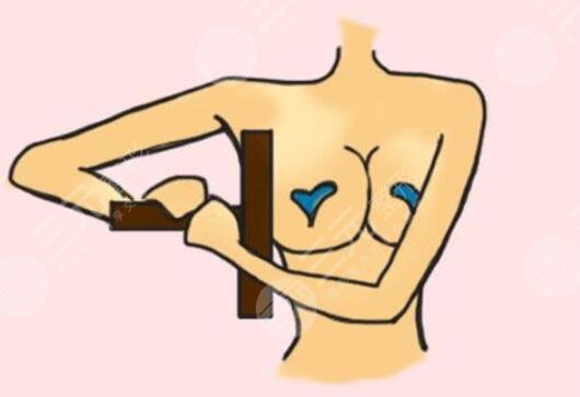 廣州天姿醫(yī)療美容醫(yī)院自體脂肪隆胸過程圖——汪海濱醫(yī)生