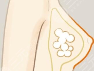 自體脂肪隆胸術(shù)后恢復(fù)圖