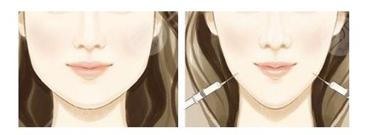 如何讓咬肌變??？