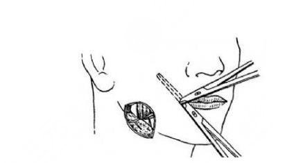 如何讓咬肌變??？