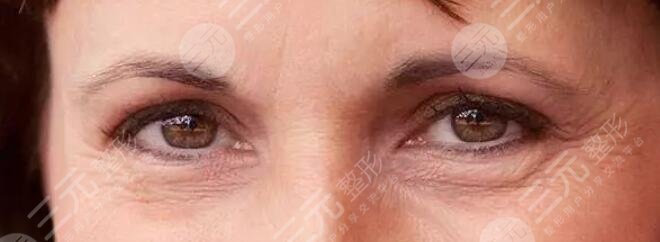 激光去魚(yú)尾紋要多久