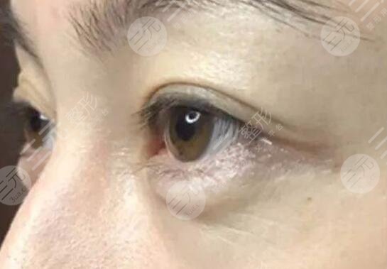 激光去魚(yú)尾紋案例前