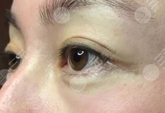 激光去魚(yú)尾紋案例后