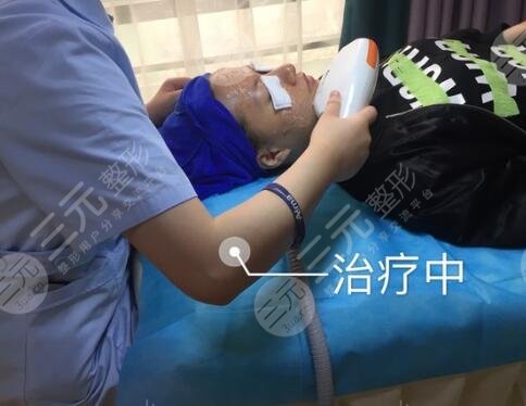 激光去魚(yú)尾紋案例中