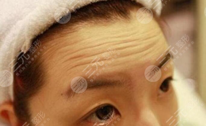 去抬頭紋大概要多少錢？深知4個(gè)原因影響了手術(shù)的價(jià)格！