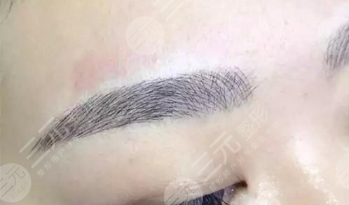 植眉毛多久能恢復(fù)正常