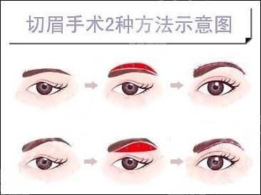 提眉術(shù)價(jià)格一般是多少