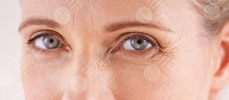 面部除皺|魚尾紋怎么去除？讓心靈之窗綻放“睛”彩