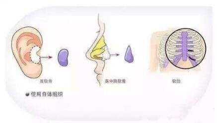 自體軟骨隆鼻缺點(diǎn)是什么？
