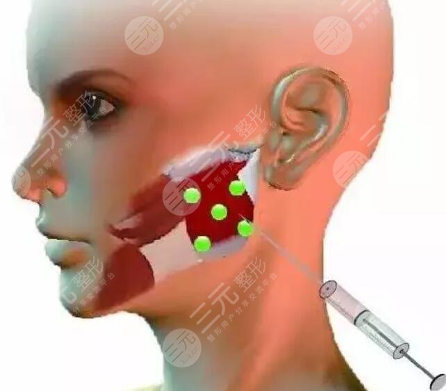 注射瘦臉多少錢