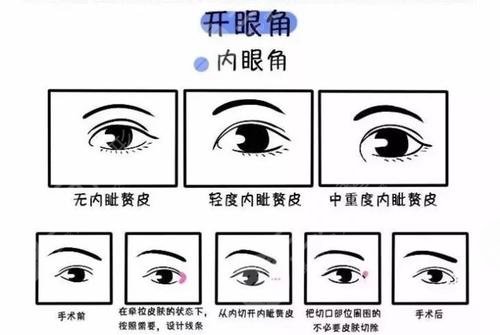 開(kāi)內(nèi)眼角