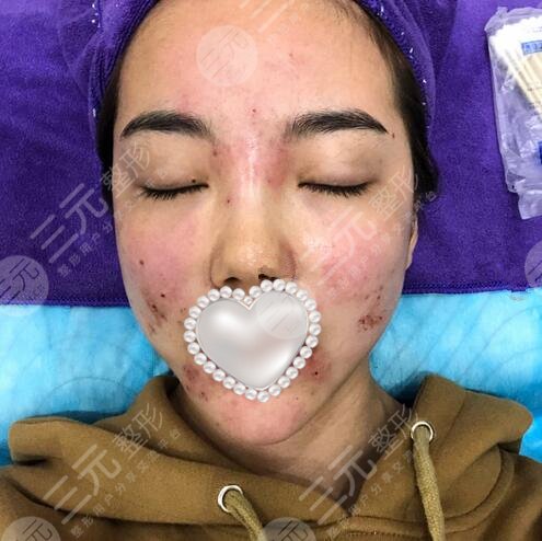 北京和顏美帕醫(yī)療美容激光祛痘案例