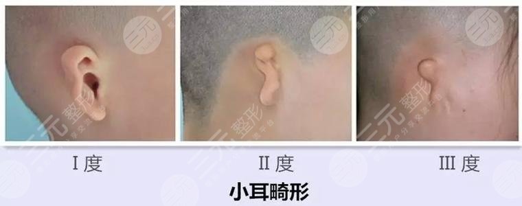 耳再造多少費用