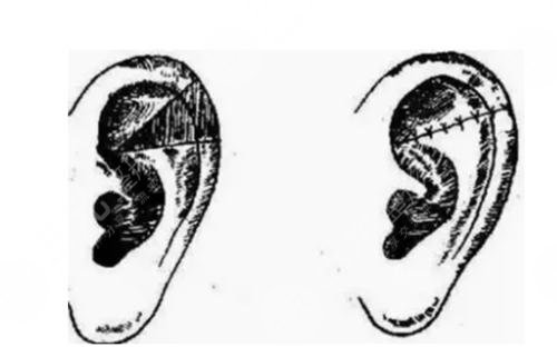 耳再造多少費用