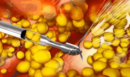 黃金微雕吸脂和普通吸脂的區(qū)別是啥？2者之間應(yīng)該怎么選呢？