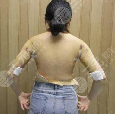 做吸脂手術(shù)前