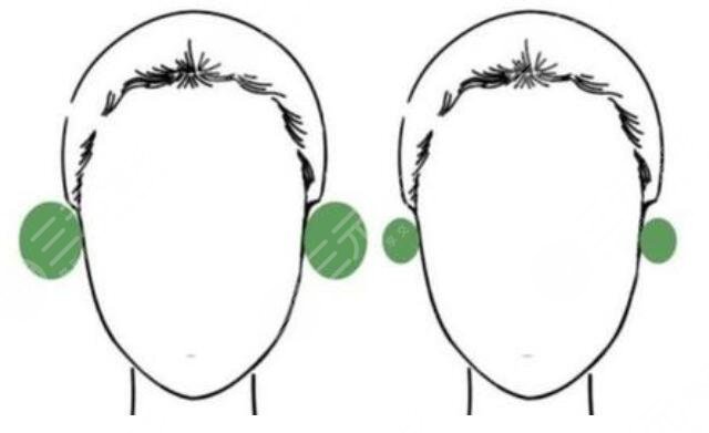先天性顱耳角在30°-60°之間矯正多少錢