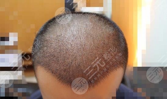 常州新生毛發(fā)醫(yī)院大面積脫發(fā)植發(fā)經歷分享