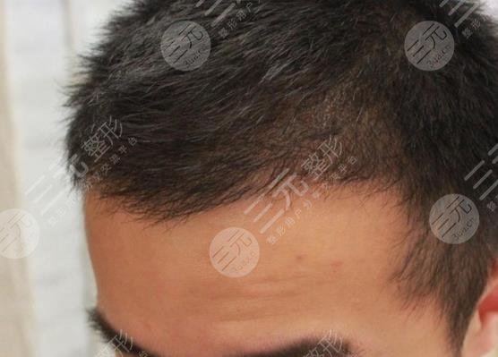 常州新生毛發(fā)醫(yī)院大面積脫發(fā)植發(fā)經歷分享
