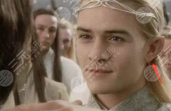 顱耳角在30°-60°之間朵怎么整形