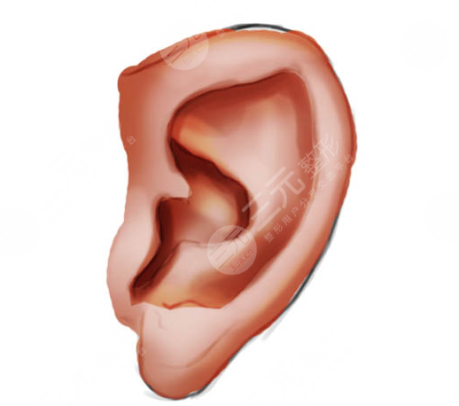 郭樹(shù)忠再造耳費(fèi)用