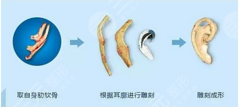 郭樹(shù)忠再造耳費(fèi)用