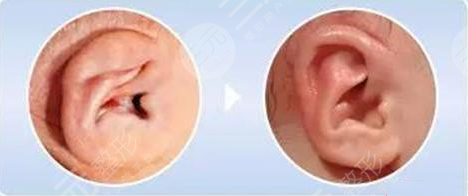 郭樹(shù)忠再造耳費(fèi)用