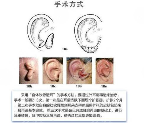耳再造手術(shù)費用