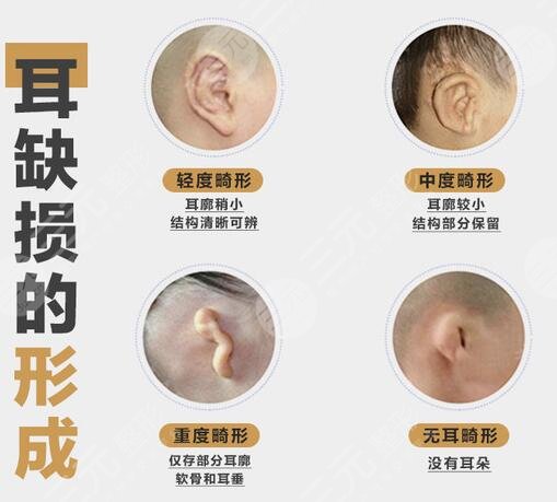 耳再造手術(shù)適合時間