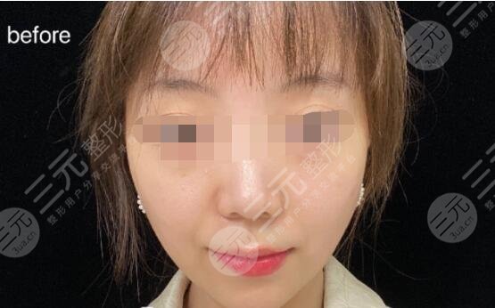 光電提拉術(shù)前