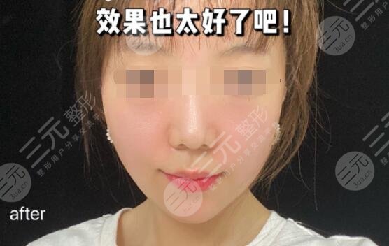 光電提拉術(shù)后