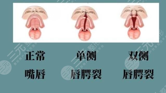 唇腭裂疤痕修復(fù)的方法介紹