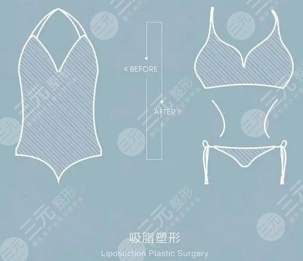 網(wǎng)絡瘋傳的超脂塑吸脂到底啥來頭