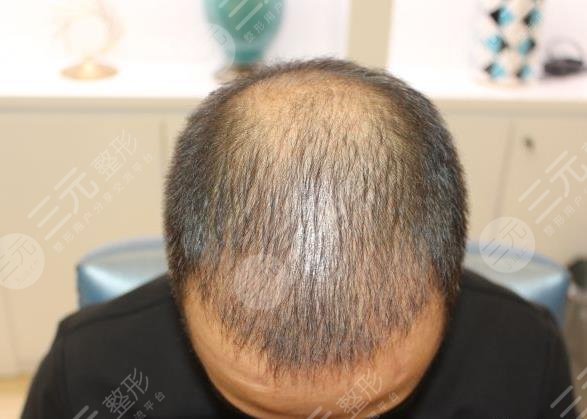 合肥新生植發(fā)醫(yī)院大面積植發(fā)案例分享