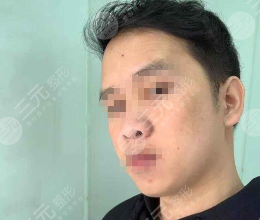 合肥新生植發(fā)醫(yī)院大面積植發(fā)案例分享