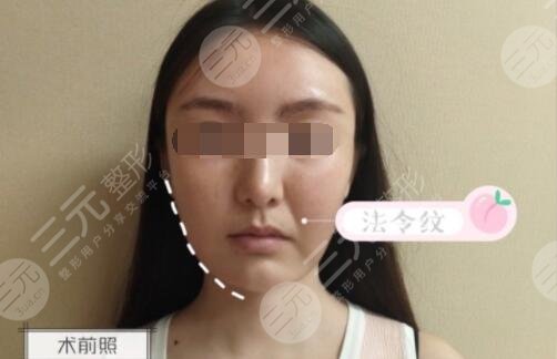 3d射頻緊膚去皺經(jīng)典案例