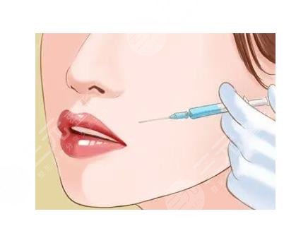 法令紋填充有后遺癥嗎