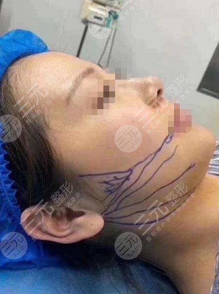 沈陽百嘉麗醫(yī)療美容醫(yī)院面部射頻溶脂案例分享：瘦臉之前