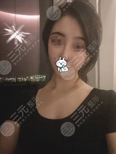 沈陽百嘉麗醫(yī)療美容醫(yī)院面部射頻溶脂案例分享：