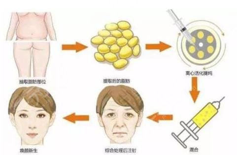 脂肪填充多久能恢復(fù)？填充臉部需要多少錢？附價(jià)格表+相關(guān)介紹