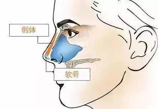 隆鼻手術(shù)相關(guān)介紹