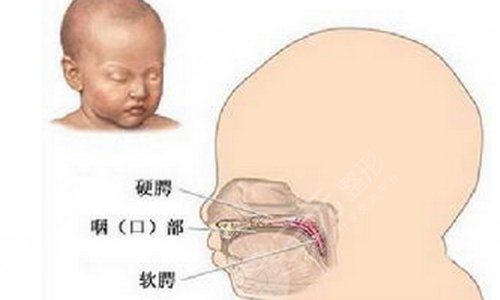 唇腭裂修復(fù)手術(shù)大概需要多少費(fèi)用？?jī)r(jià)格主要看這幾點(diǎn)...